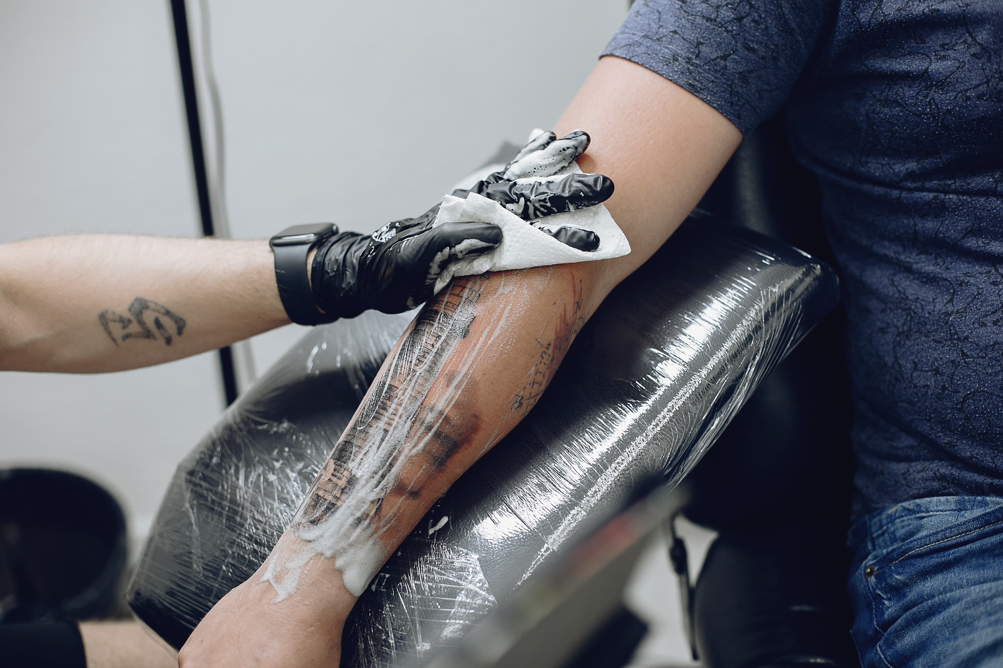 Tattoo removal treatments